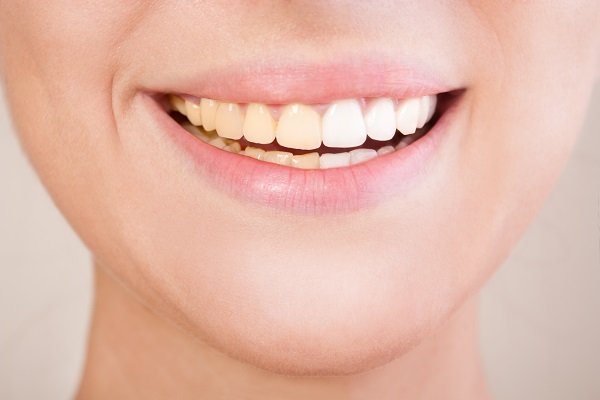 Are There Any Age Restrictions For Teeth Whitening?