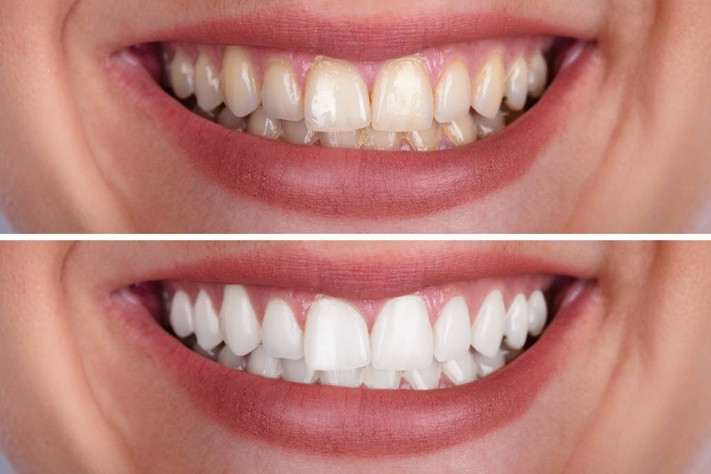 Can I safely whiten my teeth with a history of sensitive teeth?