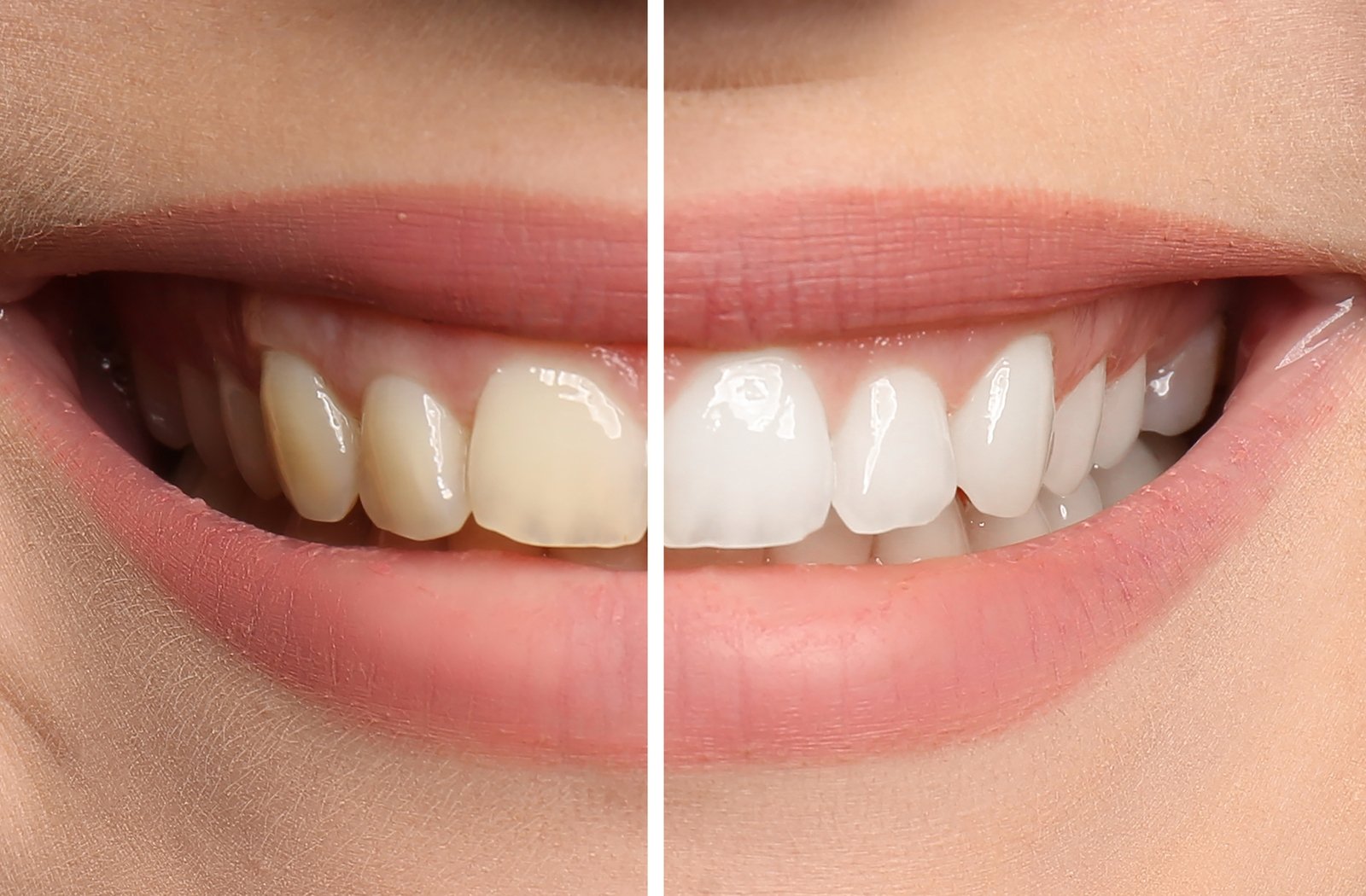 Can I safely whiten my teeth with a history of sensitive teeth?