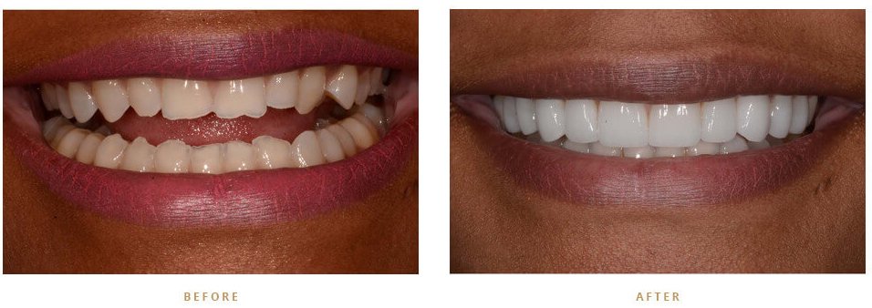 Can I whiten my teeth with dental veneers?