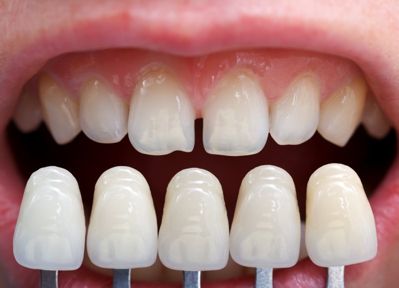 Can I whiten my teeth with dental veneers?