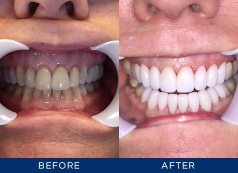 Can I whiten my teeth with dental veneers?