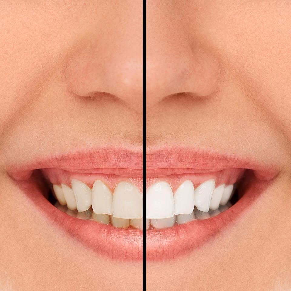 Can I whiten my teeth with dental veneers?