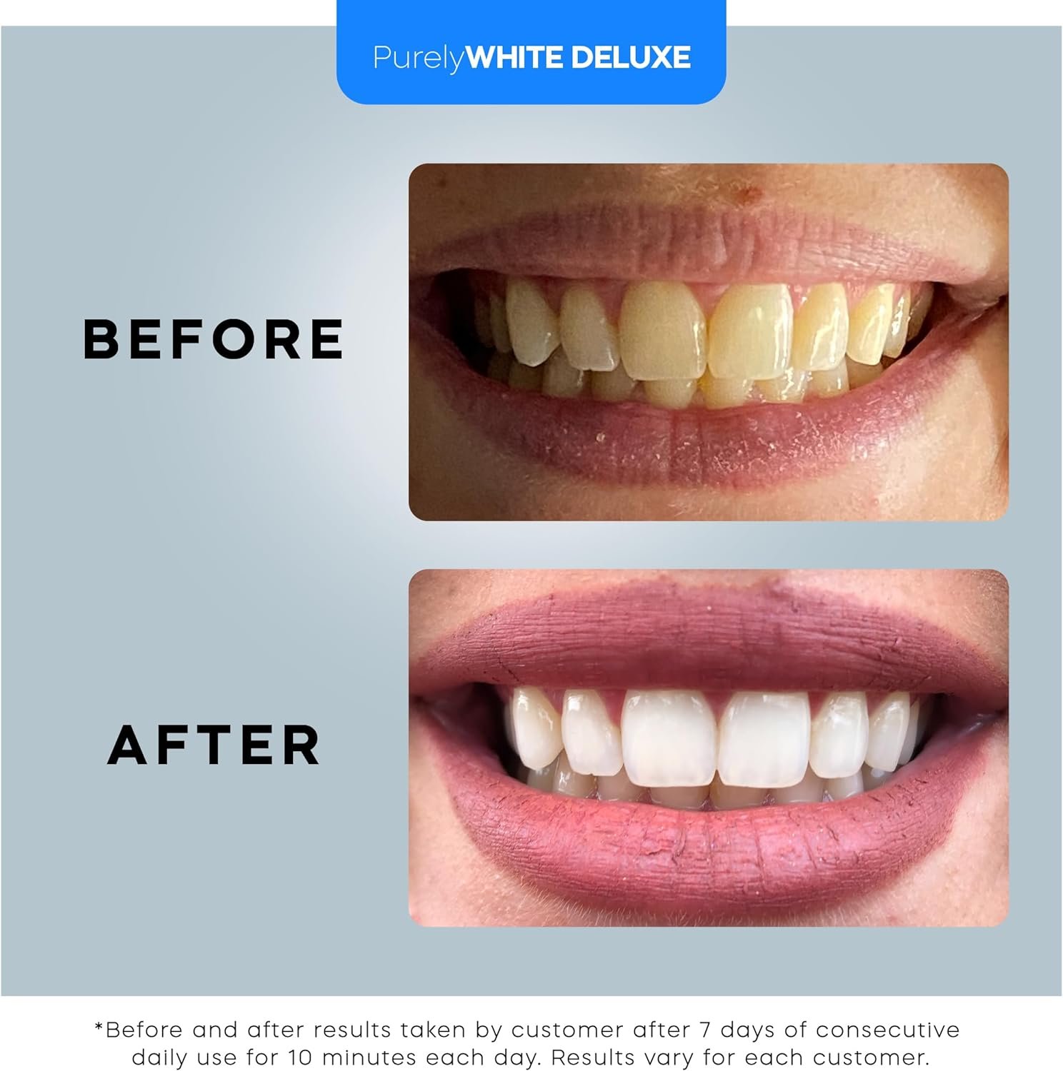 PurelyWHITE DELUXE Teeth Whitening Kit, Complete LED Teeth Whitening, 15+ Treatments, (3) 3ml Whitening Gel Syringes, Whiter Smile in 7 Minutes