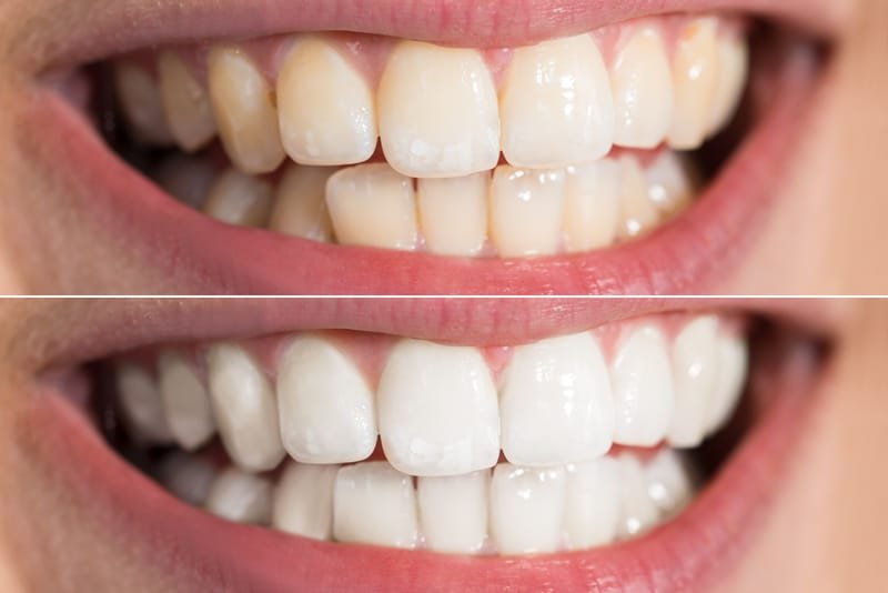 The Effect of Teeth Whitening on White Spots on Teeth