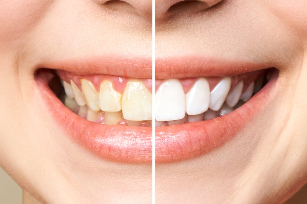 The Impact of Enamel on Teeth Sensitivity During Whitening