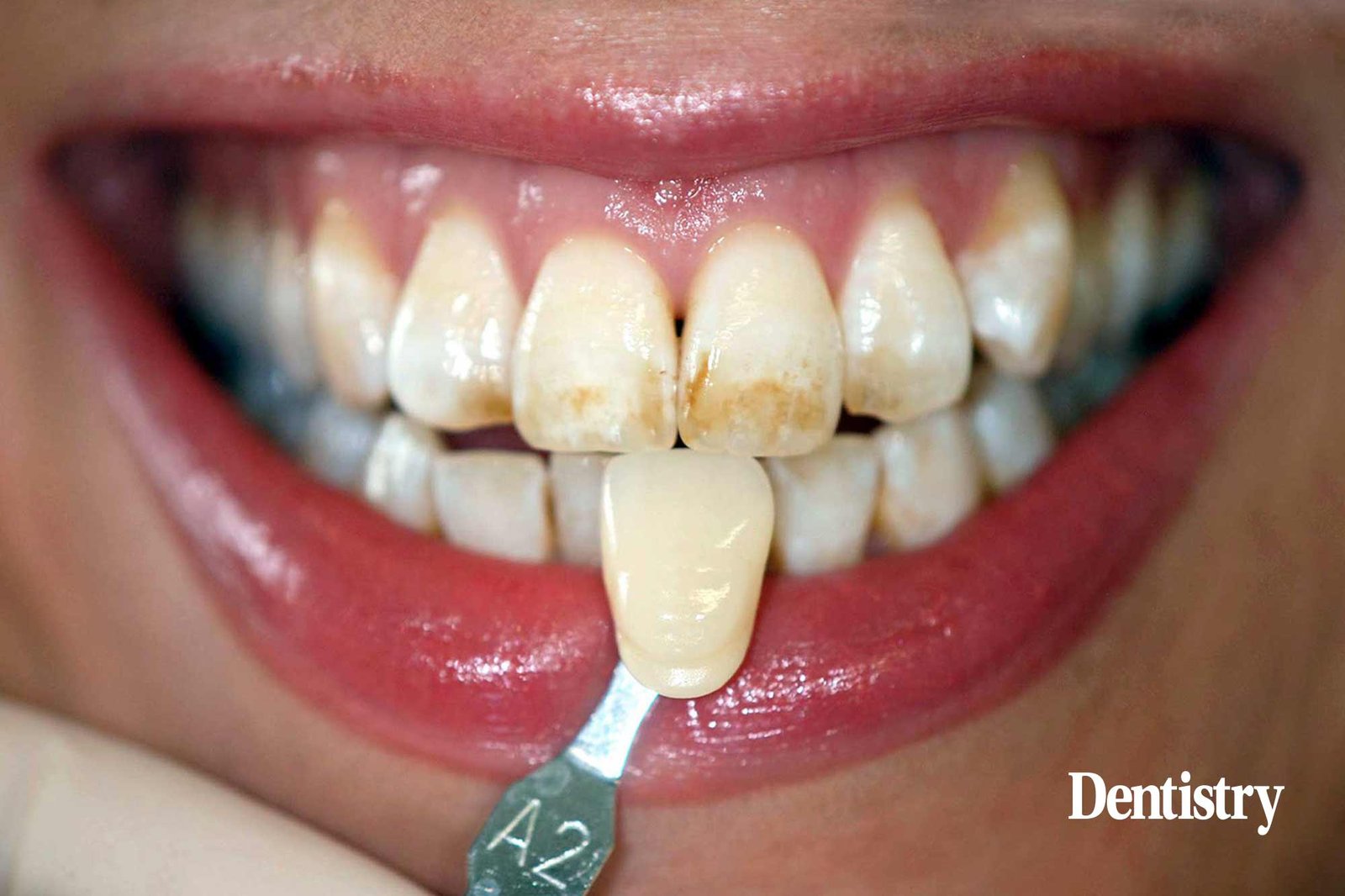 The Impact of Natural Teeth Color on Whitening Results