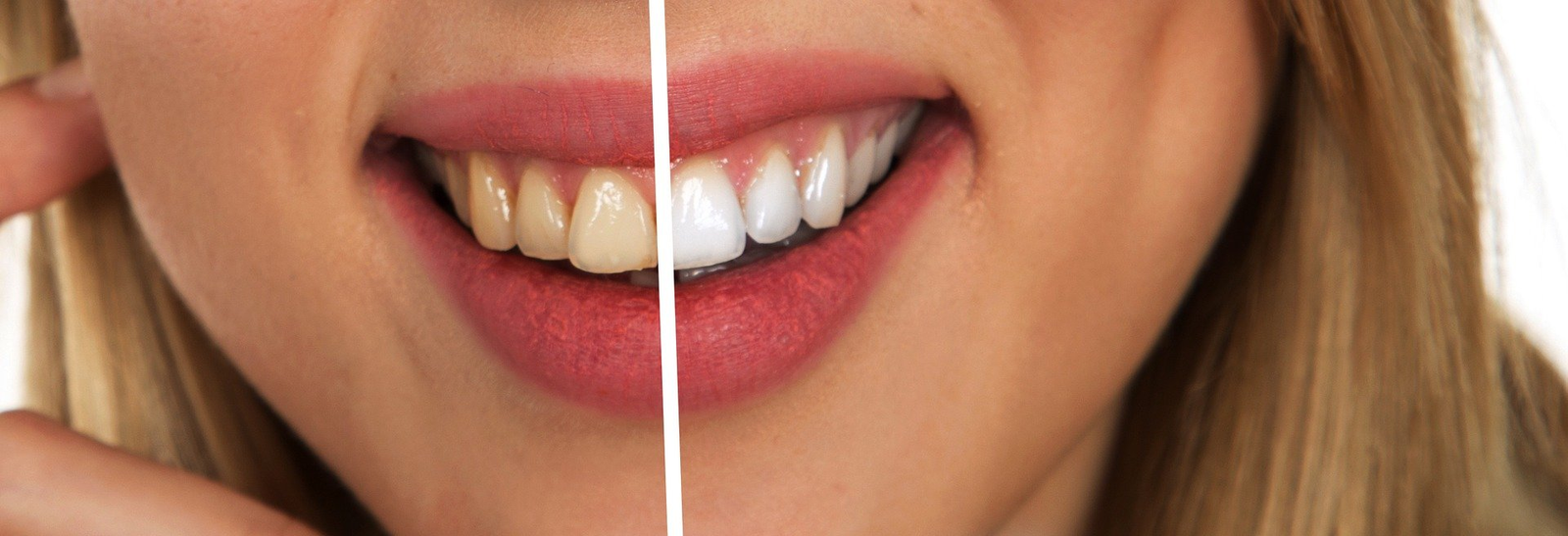 The Impact of Natural Teeth Color on Whitening Results