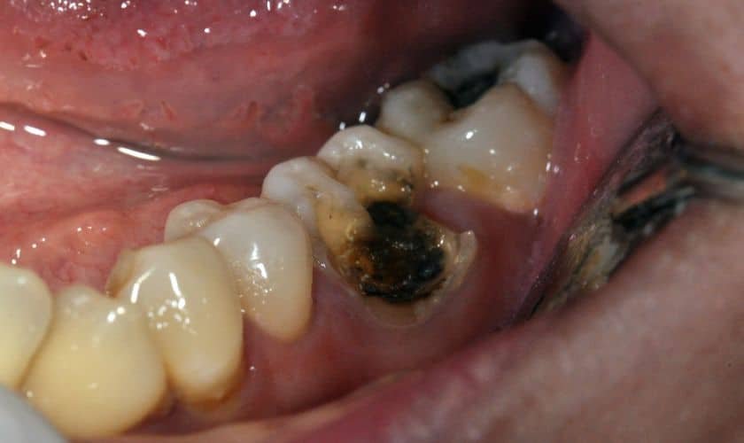 Whitening Teeth with Cavities