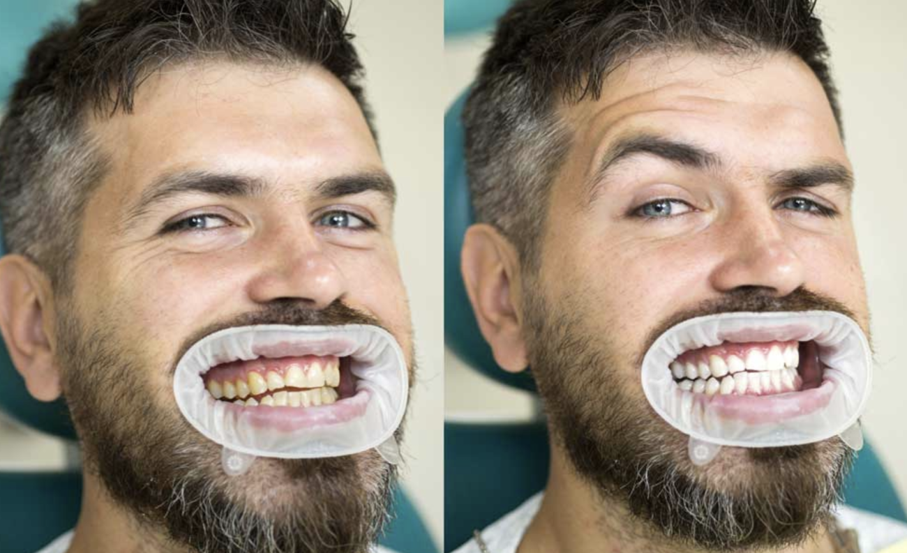 Whitening Teeth with Cavities